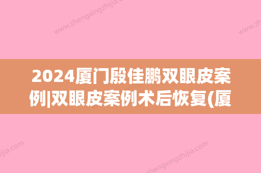 2024厦门殷佳鹏双眼皮案例|双眼皮案例术后恢复(厦门思明分院许春鹏割双眼皮)