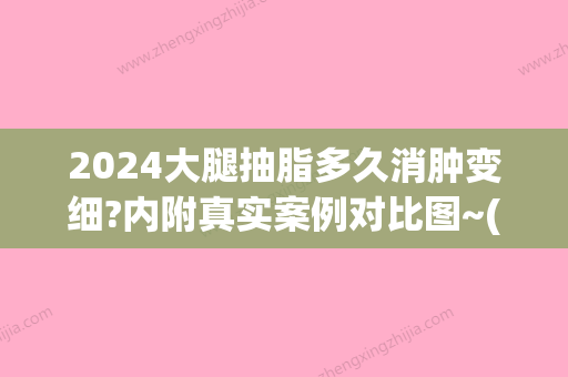 2024大腿抽脂多久消肿变细?内附真实案例对比图~(大腿抽脂多长时间消肿)