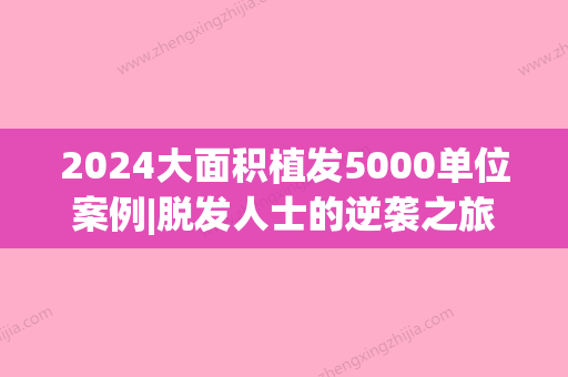 2024大面积植发5000单位案例|脱发人士的逆袭之旅~(植发的成功率)