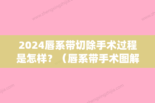 2024唇系带切除手术过程是怎样？（唇系带手术图解步骤）(唇系带延长手术后图)