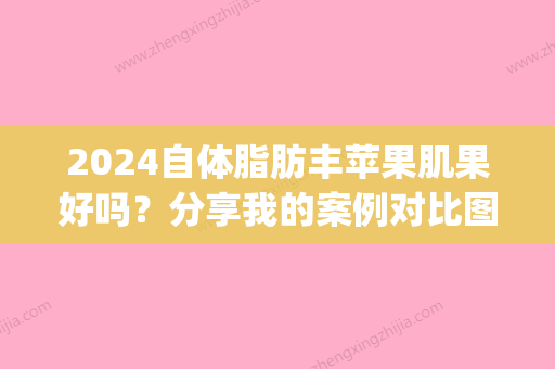 2024自体脂肪丰苹果肌果好吗？分享我的案例对比图～(自体脂肪丰苹果肌后遗症)