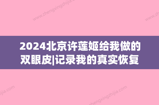 2024北京许莲姬给我做的双眼皮|记录我的真实恢复体验~(许莲姬拒绝做双眼皮)