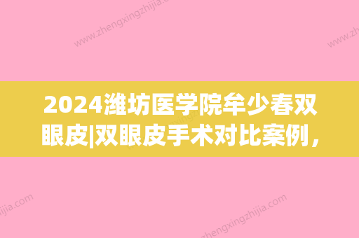 2024潍坊医学院牟少春双眼皮|双眼皮手术对比案例，内附恢复图片(潍坊医学院双眼皮医生)