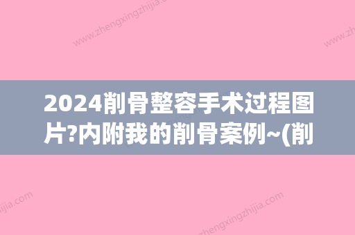 2024削骨整容手术过程图片?内附我的削骨案例~(削骨手术照片)