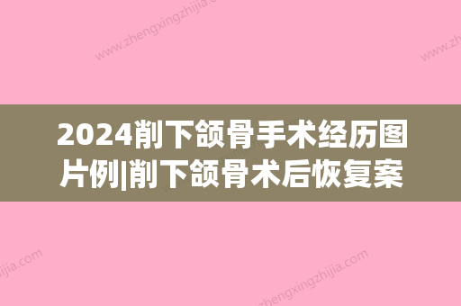 2024削下颌骨手术经历图片例|削下颌骨术后恢复案例曝光~(下颌骨切除手术恢复期)