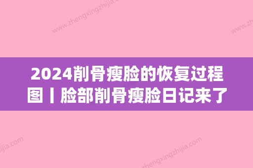 2024削骨瘦脸的恢复过程图丨脸部削骨瘦脸日记来了~(削骨瘦脸前后对比照)