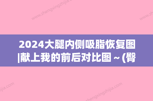 2024大腿内侧吸脂恢复图|献上我的前后对比图～(臀部腿部吸脂恢复图)