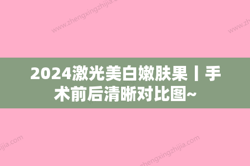 2024激光美白嫩肤果丨手术前后清晰对比图~