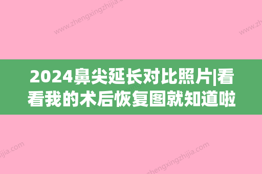 2024鼻尖延长对比照片|看看我的术后恢复图就知道啦～(鼻头延长对比照片)