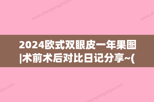 2024欧式双眼皮一年果图|术前术后对比日记分享~(2024双眼皮)