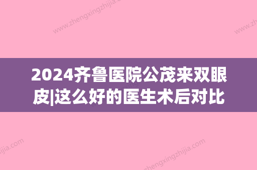 2024齐鲁医院公茂来双眼皮|这么好的医生术后对比图分享~