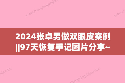 2024张卓男做双眼皮案例||97天恢复手记图片分享~(石家庄张卓男割双眼皮)