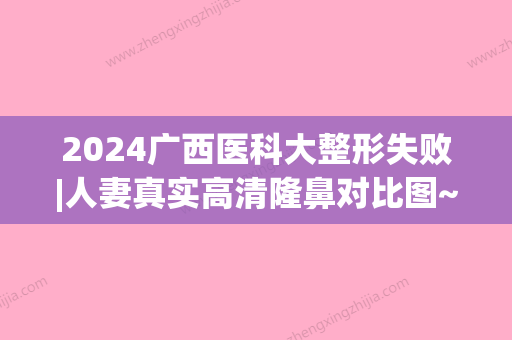 2024广西医科大整形失败|人妻真实高清隆鼻对比图~(广西医科大学整形外科)