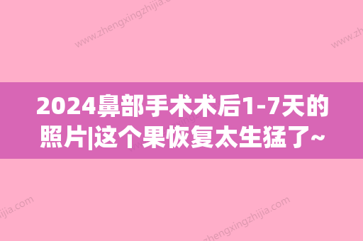 2024鼻部手术术后1-7天的照片|这个果恢复太生猛了~(鼻子术后多久完全恢复)