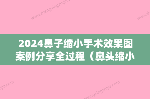 2024鼻子缩小手术效果图案例分享全过程（鼻头缩小手术图片）(鼻头缩小手术对比效果图)