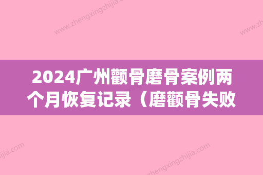 2024广州颧骨磨骨案例两个月恢复记录（磨颧骨失败）(颧骨磨骨一个月图片)