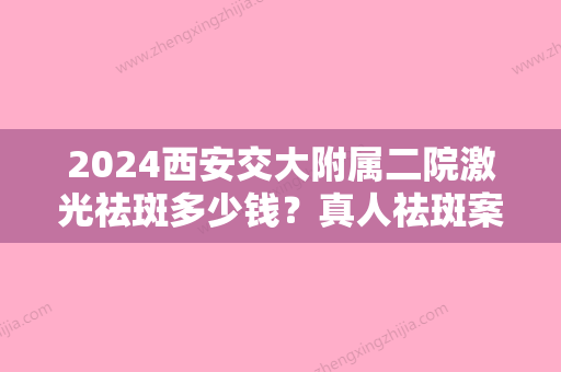 2024西安交大附属二院激光祛斑多少钱？真人祛斑案例：术后真的淡化不少！