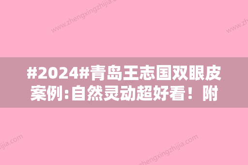 #2024#青岛王志国双眼皮案例:自然灵动超好看！附医生简介、双眼皮价格