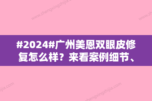 #2024#广州美恩双眼皮修复怎么样？来看案例细节、内附价格