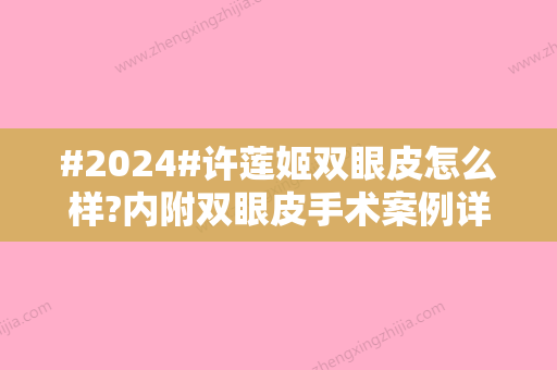 #2024#许莲姬双眼皮怎么样?内附双眼皮手术案例详情