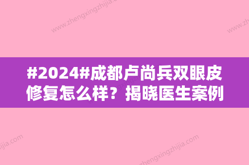 #2024#成都卢尚兵双眼皮修复怎么样？揭晓医生案例过程/坐诊医院介绍