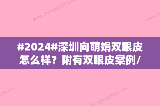 #2024#深圳向萌娟双眼皮怎么样？附有双眼皮案例/相关技术详解