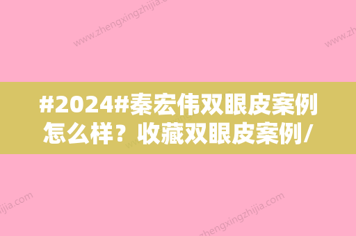 #2024#秦宏伟双眼皮案例怎么样？收藏双眼皮案例/坐诊医院简介