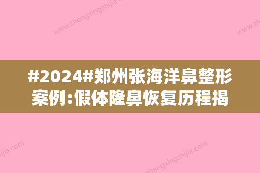 #2024#郑州张海洋鼻整形案例:假体隆鼻恢复历程揭秘！自然挺翘