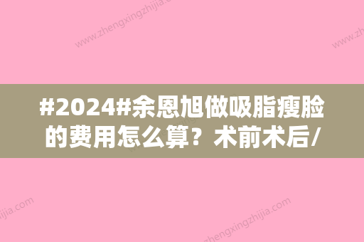 #2024#余恩旭做吸脂瘦脸的费用怎么算？术前术后/坐诊医院/价格表