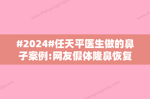 #2024#任天平医生做的鼻子案例:网友假体隆鼻恢复之后超自然！