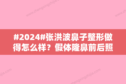 #2024#张洪波鼻子整形做得怎么样？假体隆鼻前后照与医生个性实力介绍