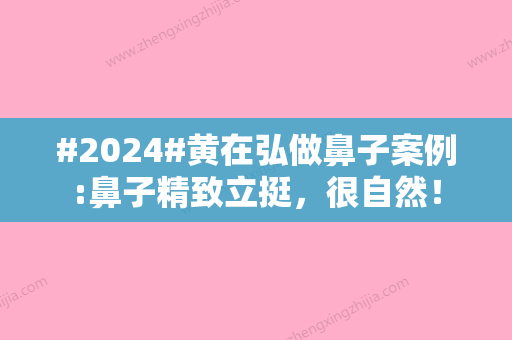 #2024#黄在弘做鼻子案例:鼻子精致立挺	，很自然！