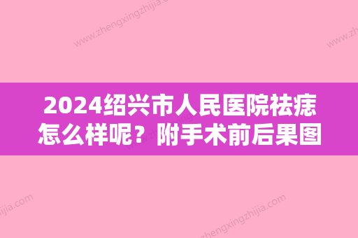 2024绍兴市人民医院祛痣怎么样呢？附手术前后果图分享+祛痣价格表2024