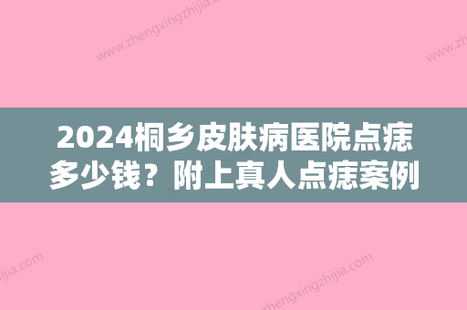 2024桐乡皮肤病医院点痣多少钱？附上真人点痣案例+2024价格表参考