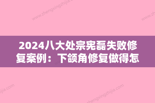 2024八大处宗宪磊失败修复案例：下颌角修复做得怎么样呢？手术失败都有哪些并发症呢？