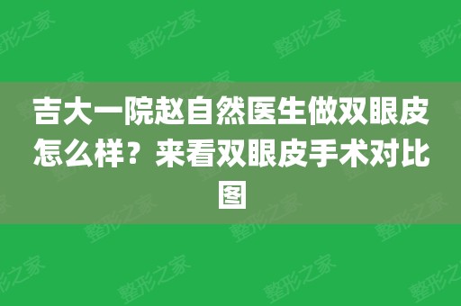 吉大一院赵自然医生做双眼皮怎么样?来看双眼皮手术对比图