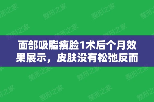 面部吸脂瘦脸1术后个月效果展示，皮肤没有松弛反而更紧致