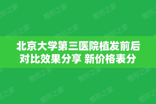 北京大学第三医院植发前后对比效果分享 新价格表分享