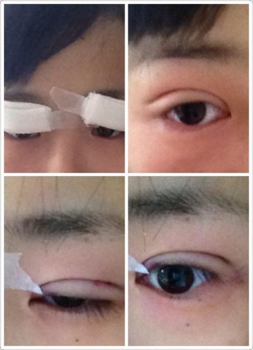 【埋线双眼皮手术恢复过程】 埋线双眼皮手术恢复过程图